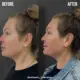 Facial Balancing With Fillers - Aesthetic Island