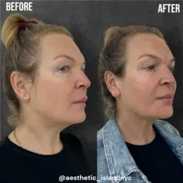 Facial Balancing With Fillers - Aesthetic Island