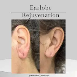 Earlobe Rejuvenation - Aesthetic Island