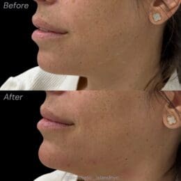 Chin Filler Brooklyn