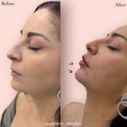Lip & Chin Filler