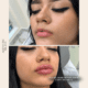 Lip Filler