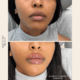 Lip Filler