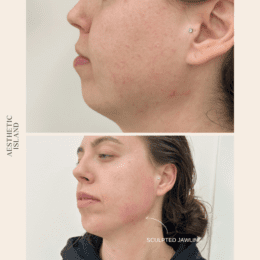 Chin & Jaw Filler