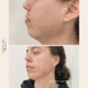 Chin & Jaw Filler