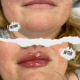 Lip Filler