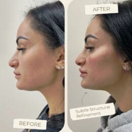 Filler Facial Balancing