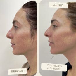 Sculptra Treatment