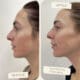 Sculptra Treatment