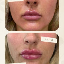 Lip Filler Treatment