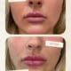 Lip Filler Treatment