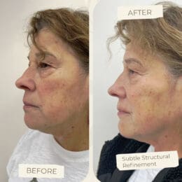 Filler Facial Balancing
