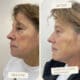 Filler Facial Balancing