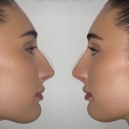 Nose Job With PDO Threads