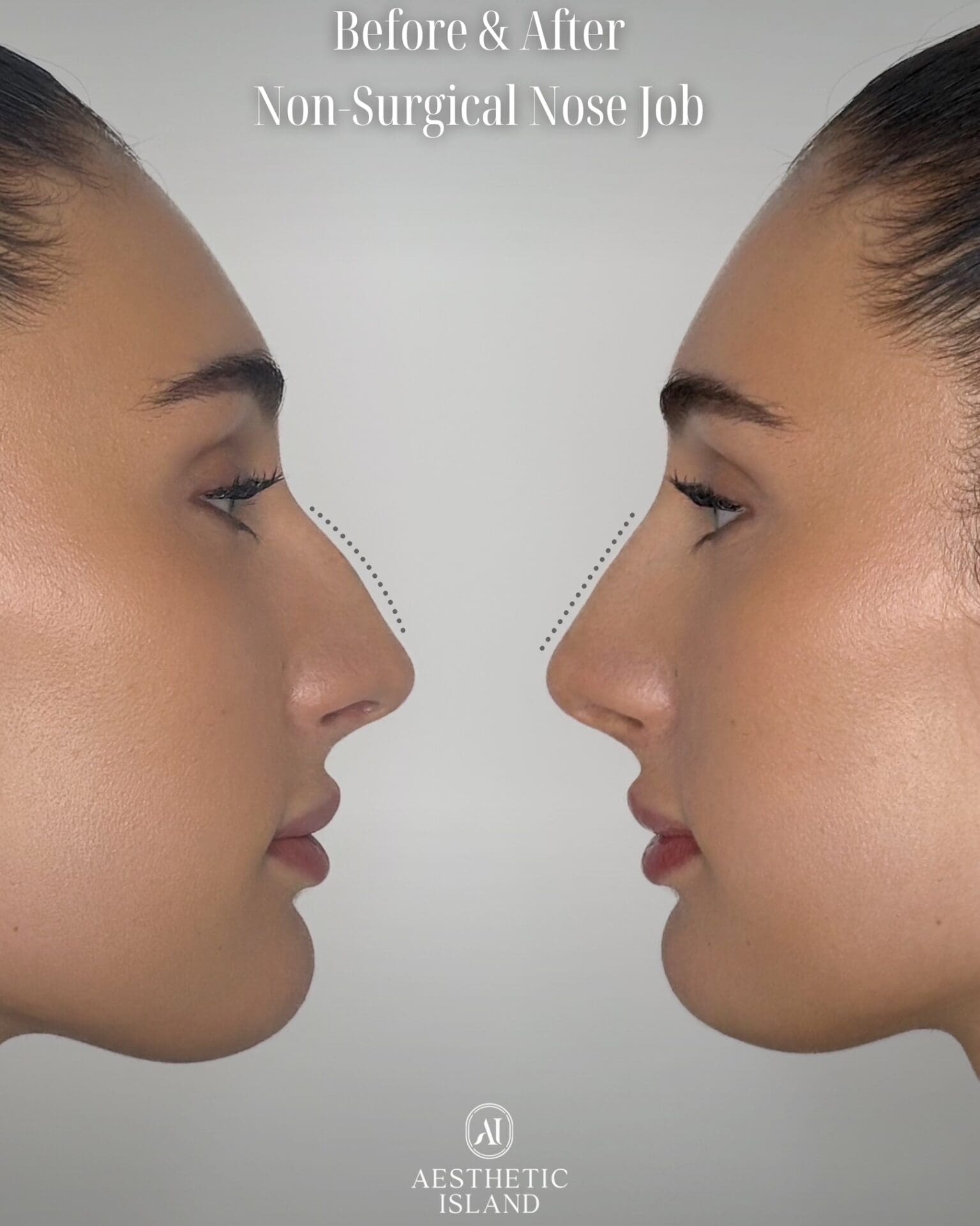 Nose Job With PDO Threads