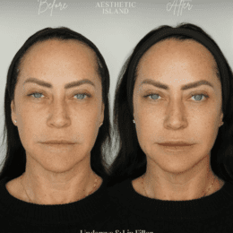 Undereye & Lip Filler