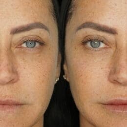Undereye & Lip Filler