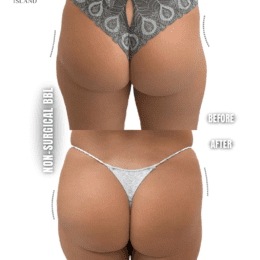 Non-Surgical BBL