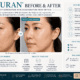 Rejuran Before and After: What Results Can You Expect?