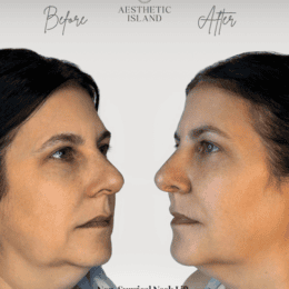Ultherapy Brooklyn, NY - Non Surgical Neck Lift