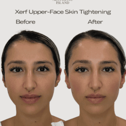 Xerf Skin Tightening Brooklyn NY Before & After