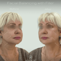 Facial Balancing With Filler In Brooklyn, NY
